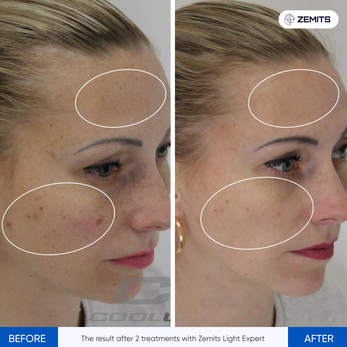 Zemits Light Expert 2.0 IPL Laser Machine