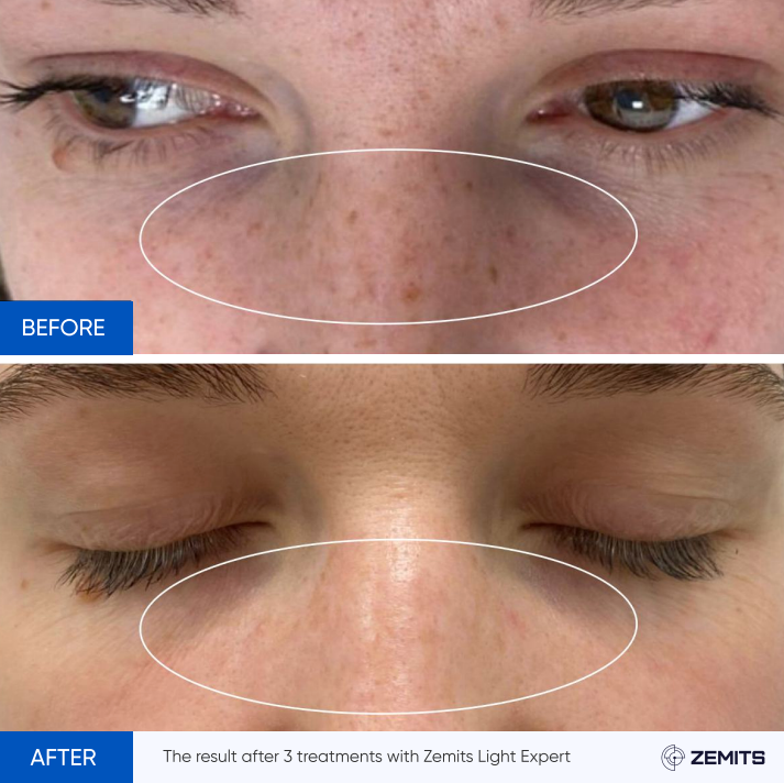 Zemits Light Expert 2.0 IPL Laser Machine