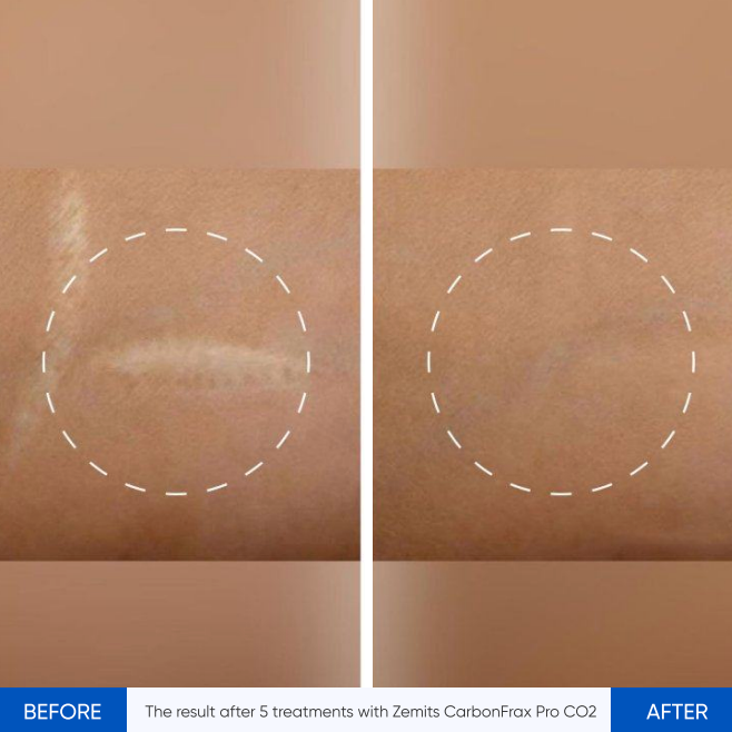 Zemits CarbonFrax Pro: CO2 Fractional Laser