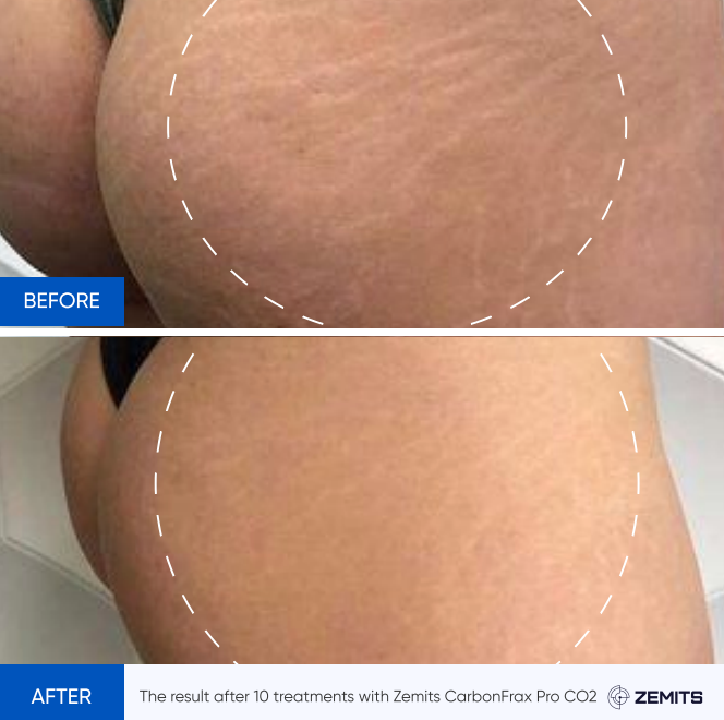 Zemits CarbonFrax Pro: CO2 Fractional Laser