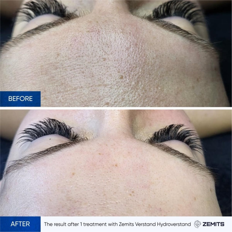 Zemits HydroVerstand PRO 7-in-1 HydroDiamond™ System