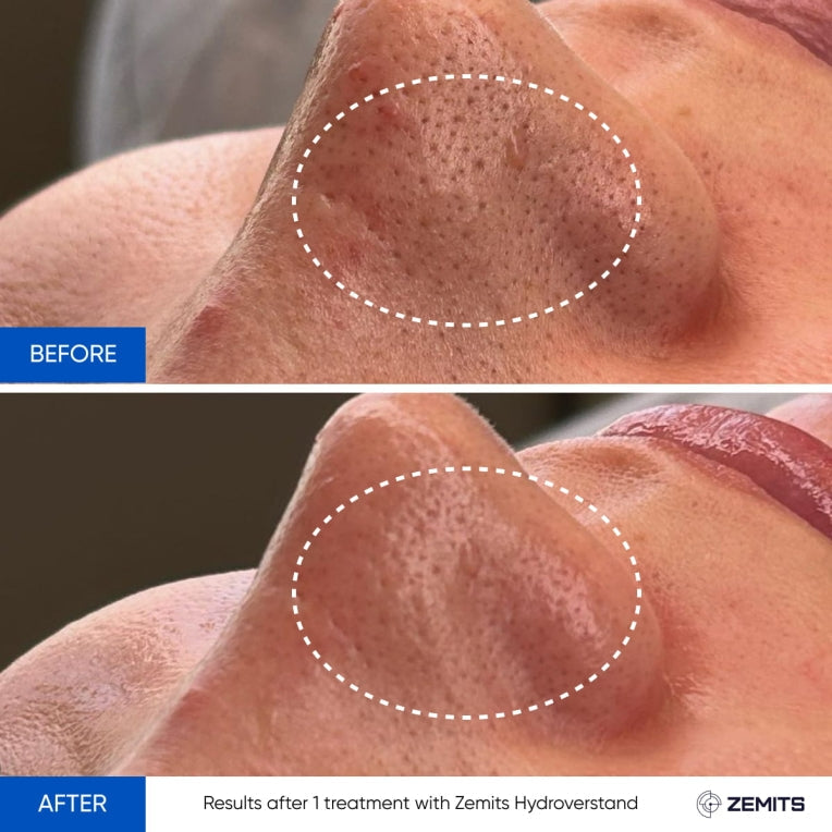 Zemits HydroVerstand PRO 7-in-1 HydroDiamond™ System
